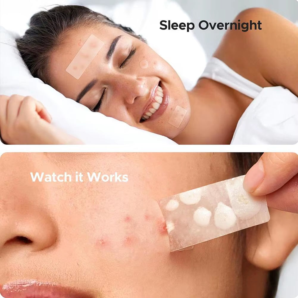 Hydrocolloid pimple patch absorbing fluid